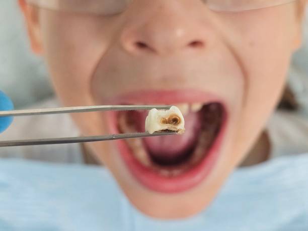 Best Broken Tooth Emergency  in Glenville, CT